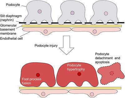 MicroRNAs in Podocyte Injury in Diabetic Nephropathy